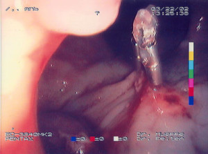 Dickdarmpolyp